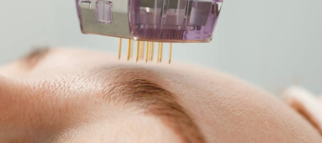 What Is The Optimal Care For Skin After Microneedling?