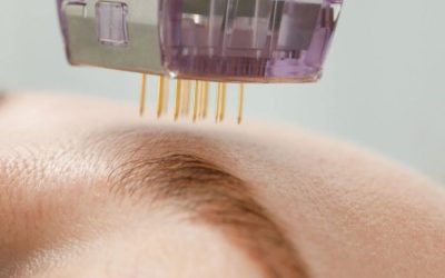 What Is The Optimal Care For Skin After Microneedling?