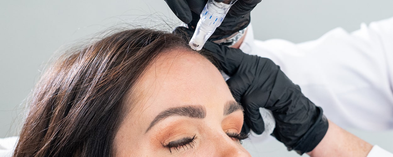 Microneedling-1
