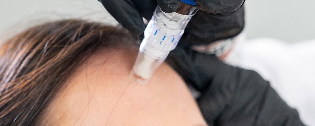 Microneedling-2 Botox Injection, Refresh Aesthetics