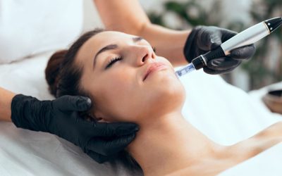 Microneedling at Refresh Aesthetics