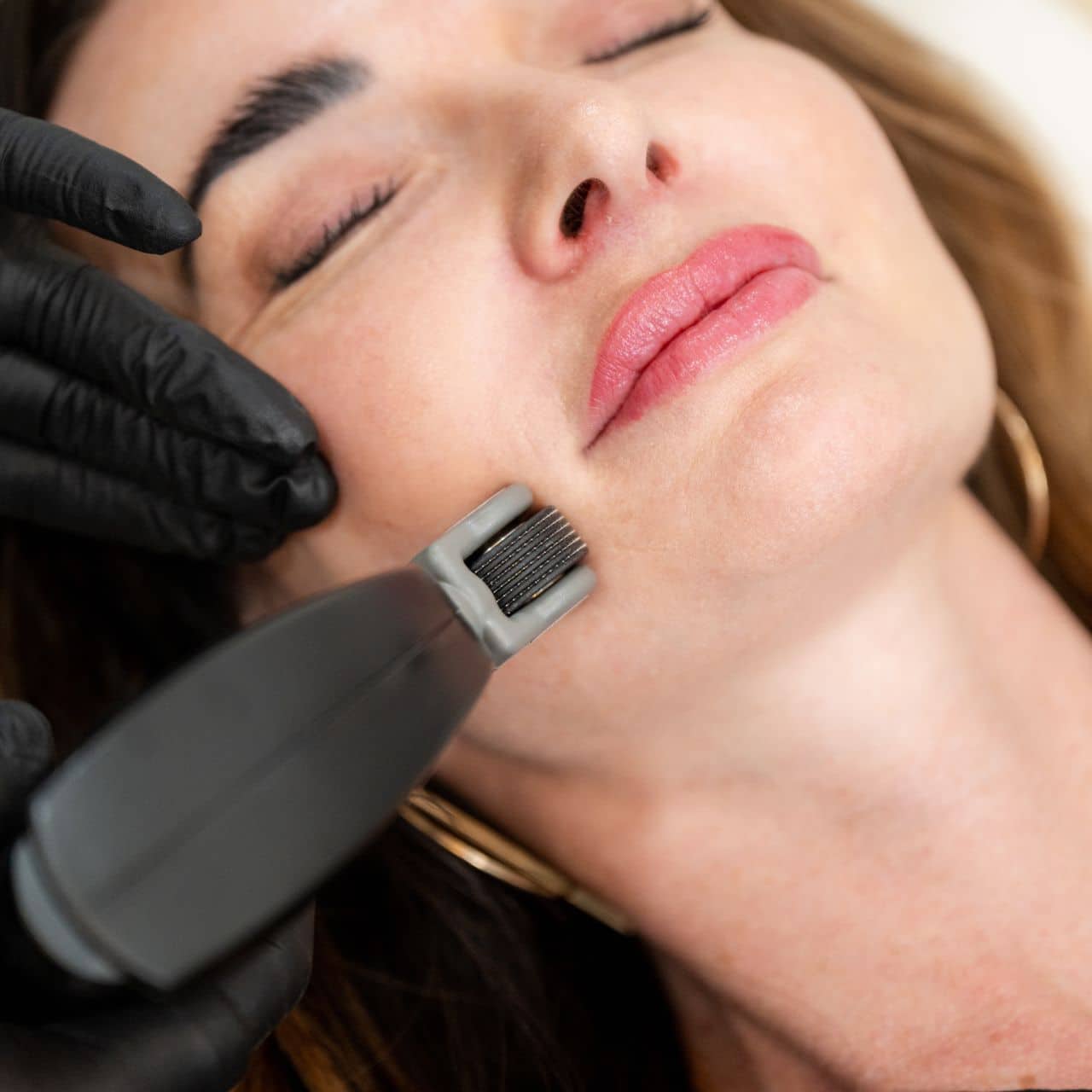 pic-image-opus-plasma-technology-1 Botox Treatment - Refresh Aesthetics